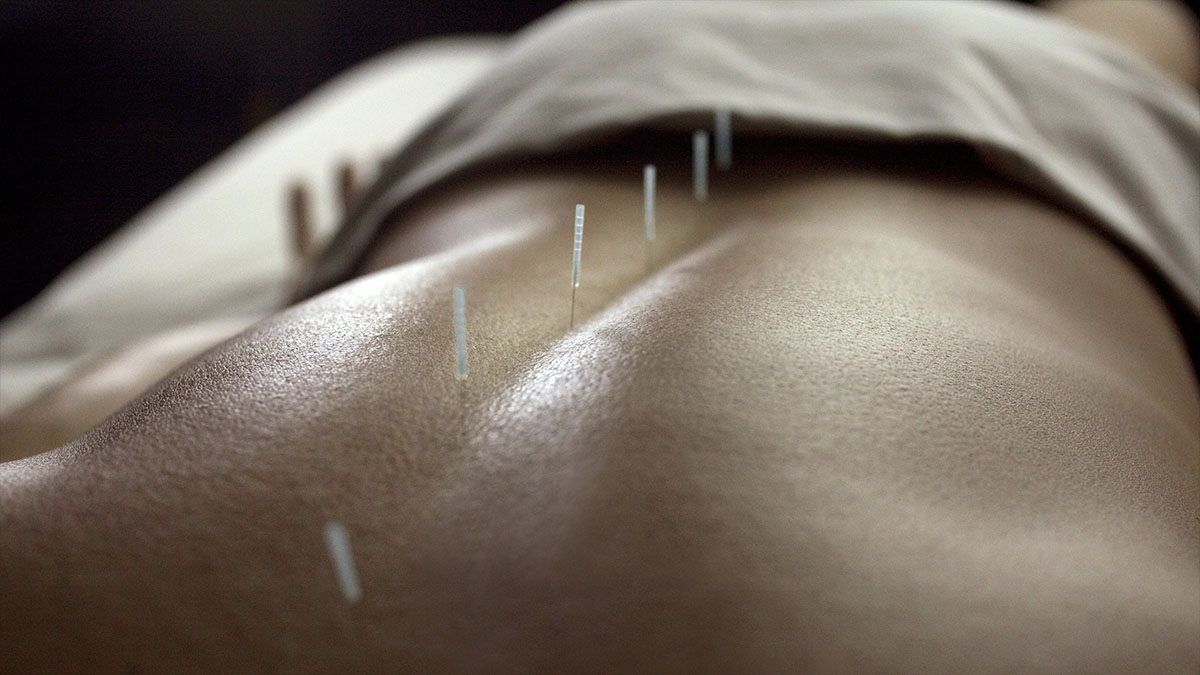 acupuncture